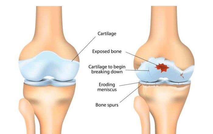 Osteoarthritis