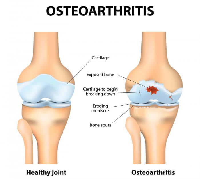 Osteoarthritis