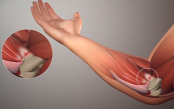 tendonitis massage